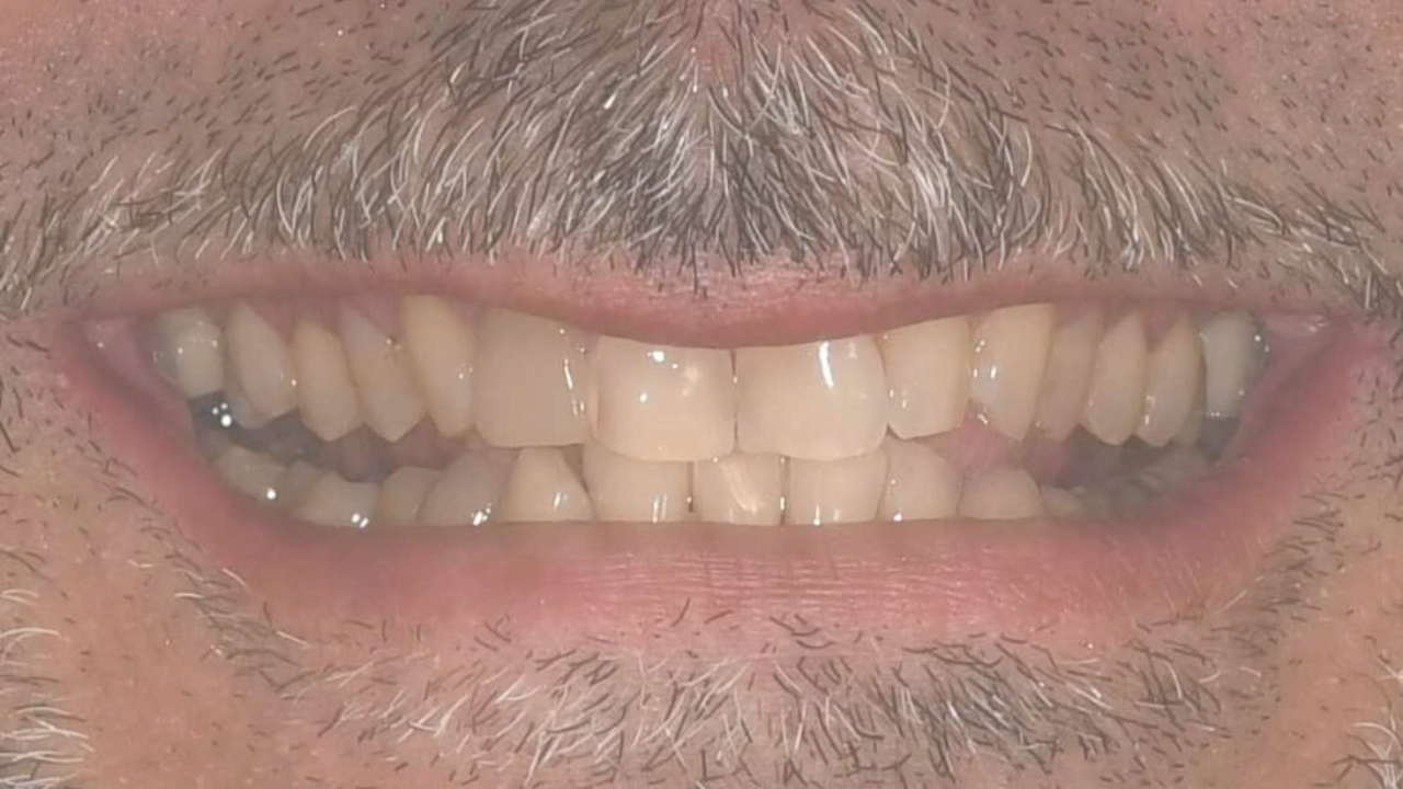 before image duchenne