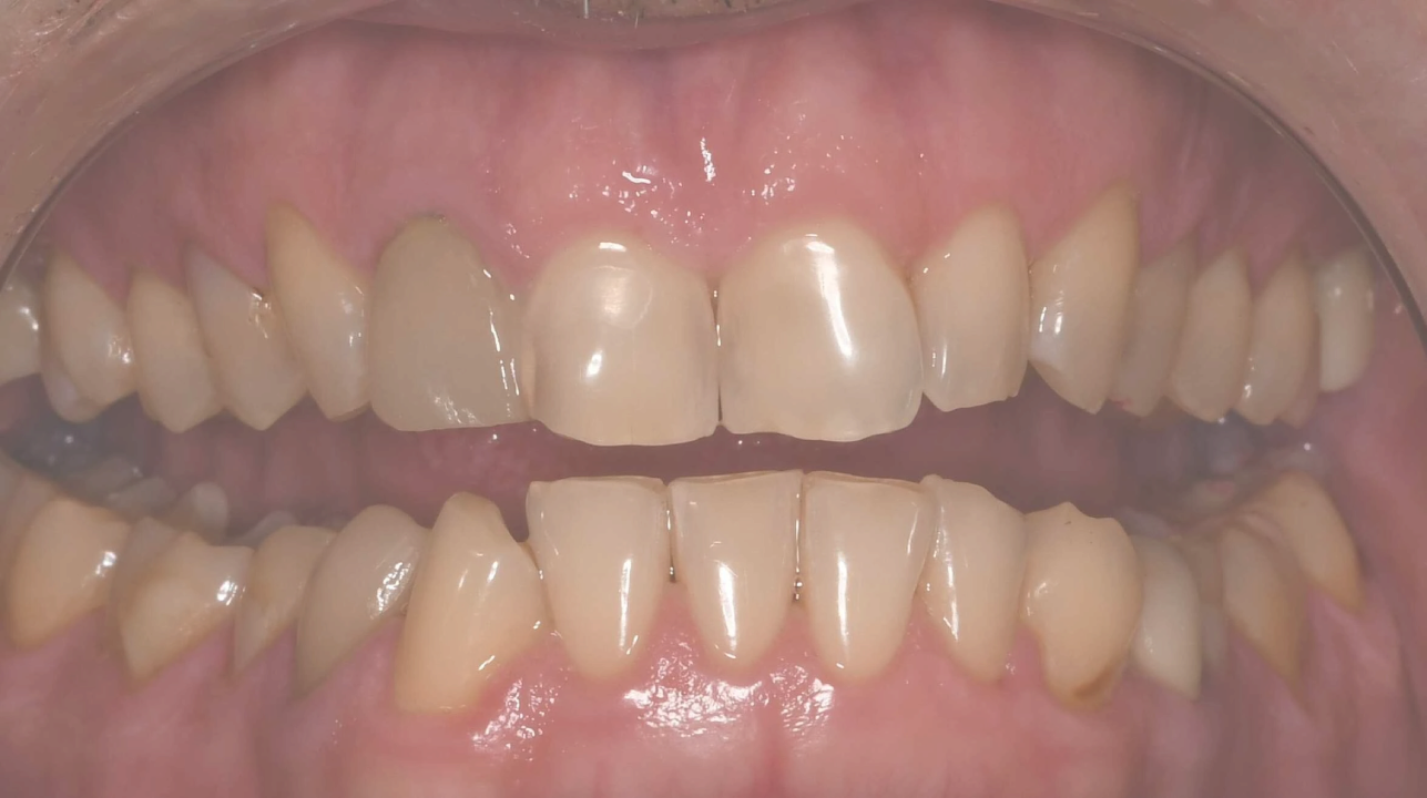 before veneers